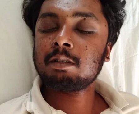 RU student returning to Rajshahi with eye injury, advised to board for treatment